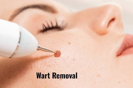 Best Wart Removal in Krishna Nagar, East Delhi